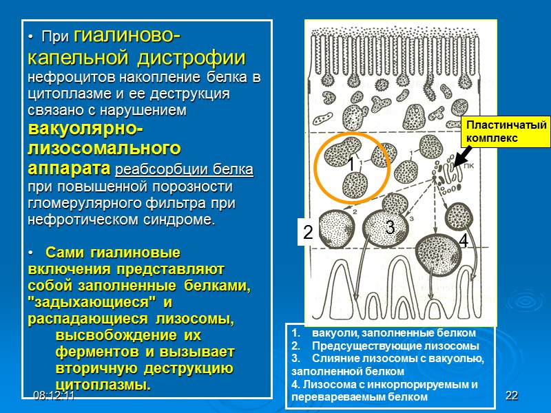 При гиалиново-капельной дистрофии нефроцитов накопление белка в цитоплазме и ее деструкция связано с нарушением